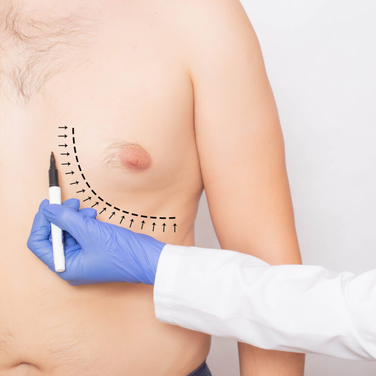 The doctor, plastic surgeon, marks with a marker the mark of a surgical operation to reduce fat on the male breast