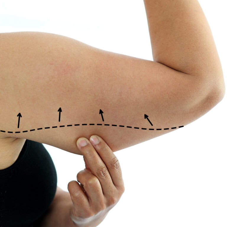 Plastic surgery doctor draw line on patient arm. Woman with excess fat on her upper arm with marks for liposuction or plastic surgery isolated on white, cosmetic surgery concept