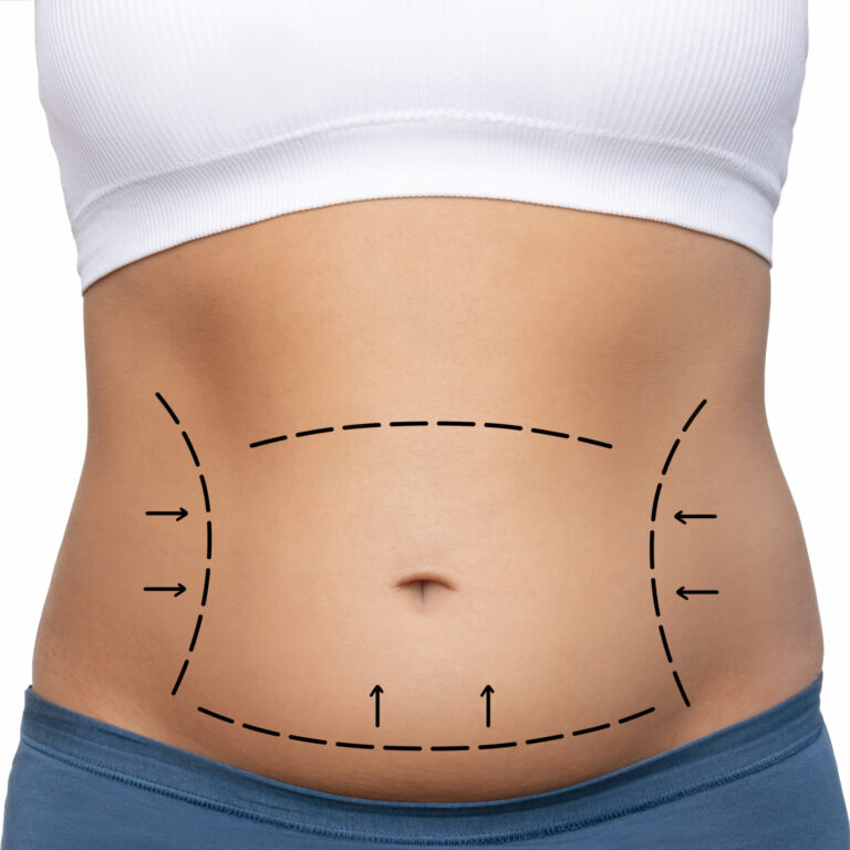 Cropped shot of a young woman's body with excess fat with marking on her belly isolated on a white background. Overweight, flabby and sagging stomach