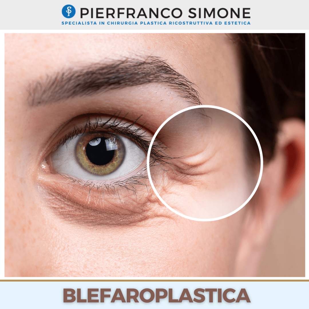 Blefaroplastica (18)